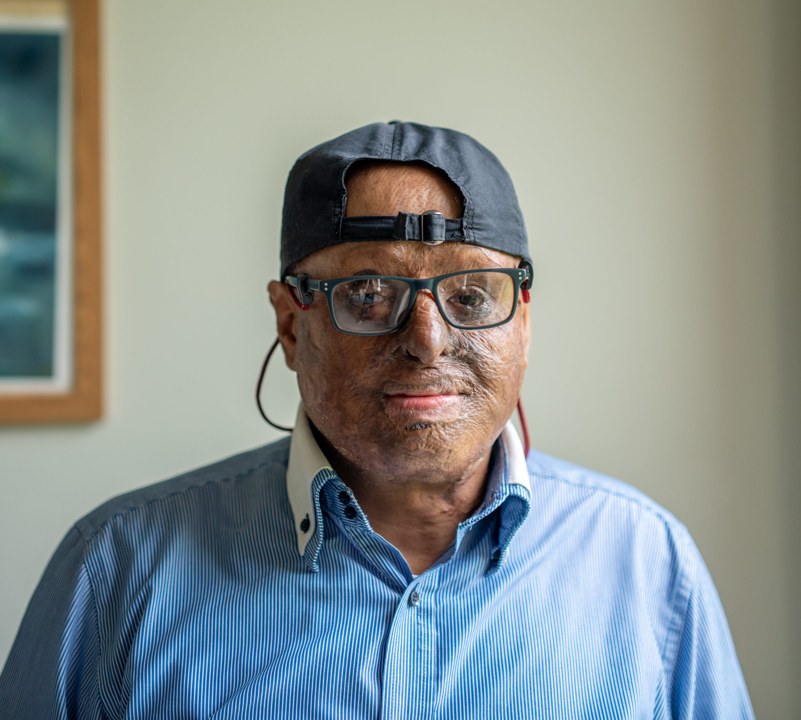 Sal burns survivor image