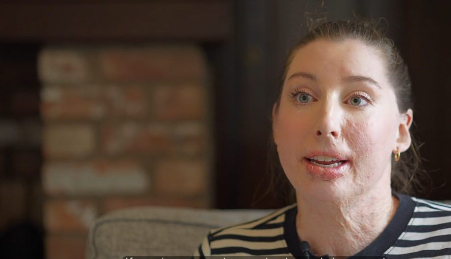 Burns survivor and physiotherapist Catrin Pugh