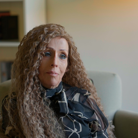 Photo of burns survivor with hair system