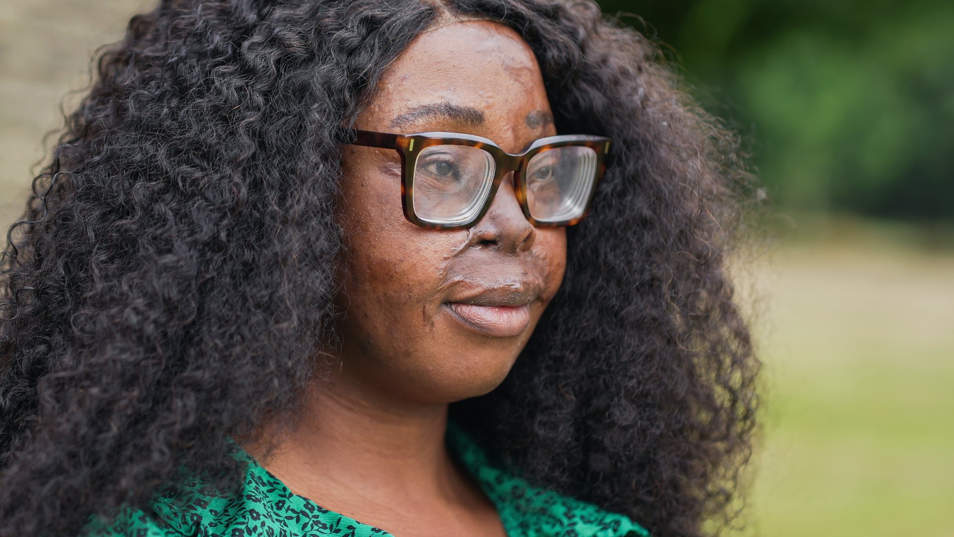 Burns Survivor Judith